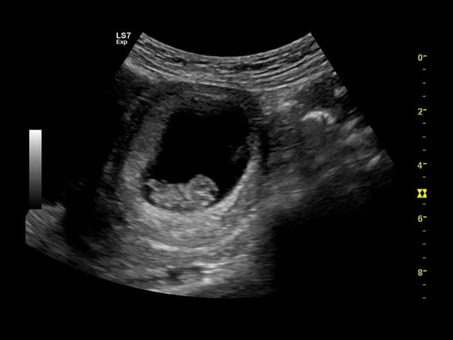 GE Logiq S7 с XDClear