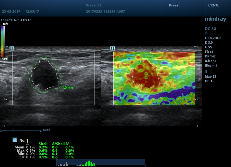 Mindray DC-80 X-Insight